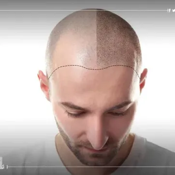 زراعة الشعر في تركيا - المميزات والأسعار وأهم المعلومات