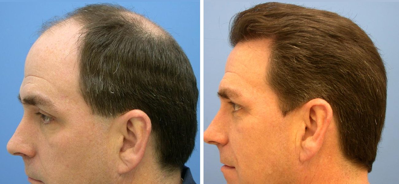 عملية زراعة الشعر