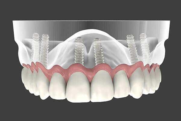  implants dentaires