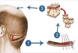 زراعة الشعر